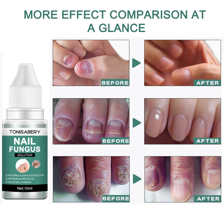 Serum Tinh Chất Phục Hồi Nấm Móng Nhanh Serum Trị Liệu Chăm Sóc Chăm Sóc Nấm Móng Chân Gel Tẩy Nấm Móng Paronychia Nấm Móng
